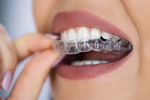 Clear Dental Aligner